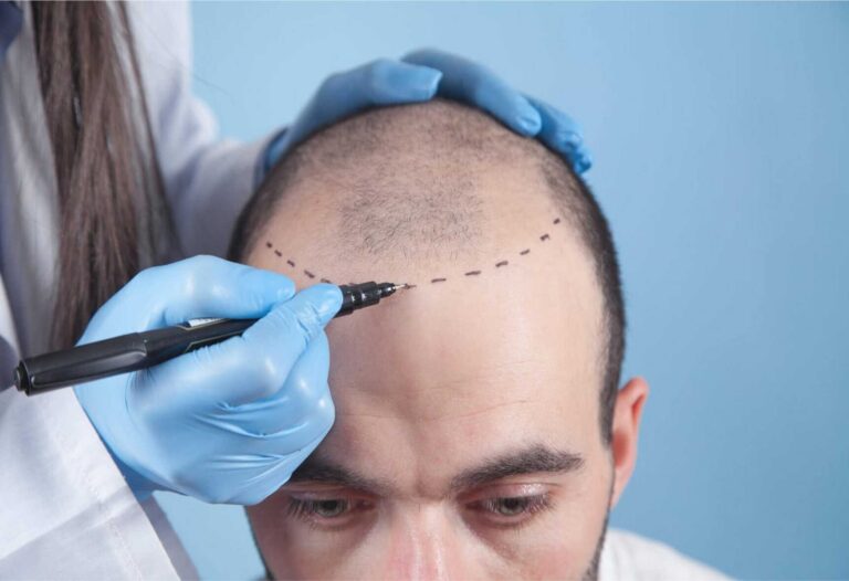 Rediscover Confidence: The Art of Hair Transplant Surgery at Resurgence Wellbeing