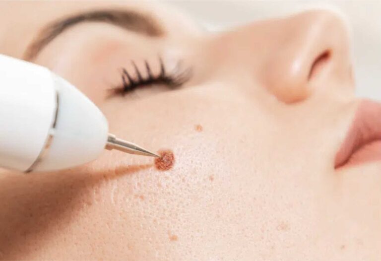 Confidence Unveiled: Mole Removal at Resurgence Wellbeing