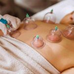 Exploring the Ancient Art of Cupping Therapy: A Holistic Approach to Well-Being