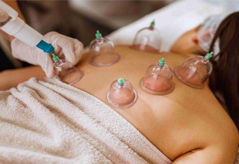 Exploring the Ancient Art of Cupping Therapy: A Holistic Approach to Well-Being